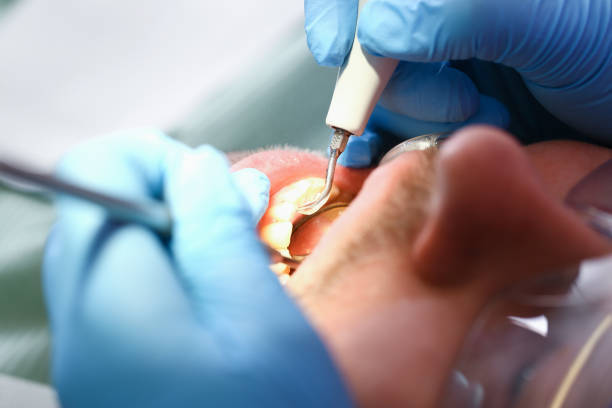 Best Broken or Cracked Tooth Emergency Dentist in Rshfield Hills, MA